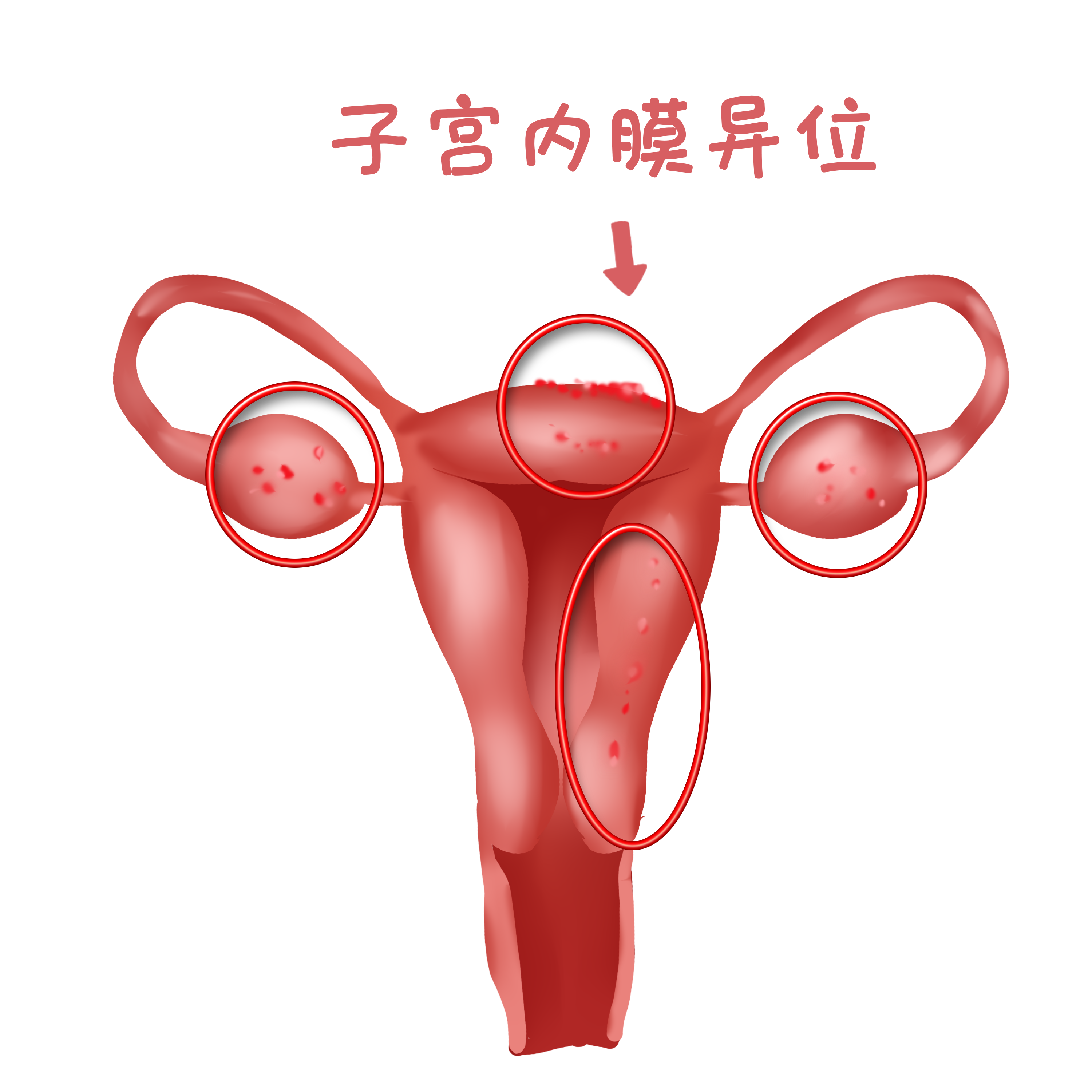子宫内膜异位.png